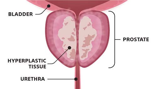 Before Rezum Procedure