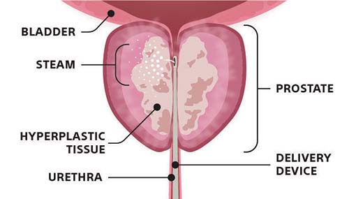 During Rezum Procedure